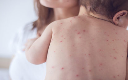 Surto de sarampo no Brasil leva mineiros a correr em busca de vacinação