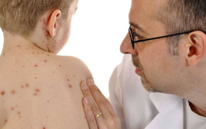 BRASIL TEM 2.192 CASOS DE SARAMPO CONFIRMADOS