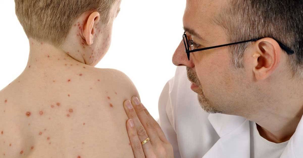 BRASIL TEM 2.192 CASOS DE SARAMPO CONFIRMADOS