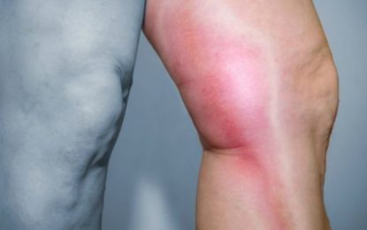 Minas Gerais registra 2.013 internações por conta de trombose em pacientes do sexo masculino no ano passado