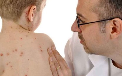 Saiba mais sobre o sarampo e como combater à doença