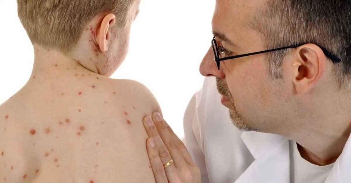 Saiba mais sobre o sarampo e como combater à doença