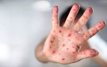 SESAPS informa sobre Sarampo e os cuidados com a doença