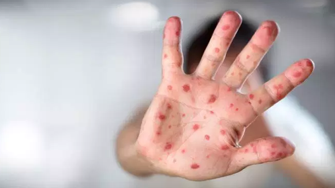 SESAPS informa sobre Sarampo e os cuidados com a doença