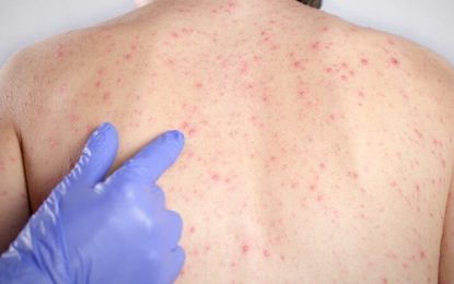 Boletim confirma aumento de 45% dos casos de sarampo em Minas