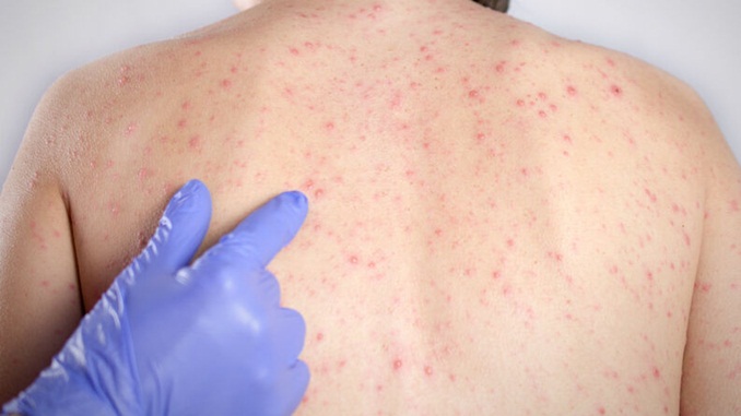 Boletim confirma aumento de 45% dos casos de sarampo em Minas