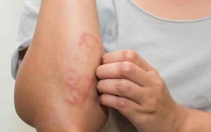 Dia Nacional de Combate e Prevenção da Hanseníase: doença registra cerca de 30 mil novos casos por ano no Brasil