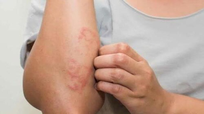 Dia Nacional de Combate e Prevenção da Hanseníase: doença registra cerca de 30 mil novos casos por ano no Brasil