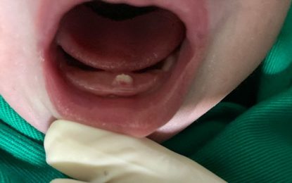 Bebê nasce com dentinho na Santa Casa de Misericórdia de Barbacena