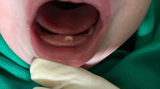 Bebê nasce com dentinho na Santa Casa de Misericórdia de Barbacena